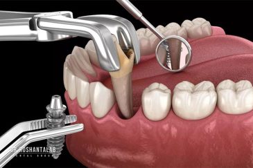 کاشت ایمپلنت چند سال بعد از کشیدن دندان