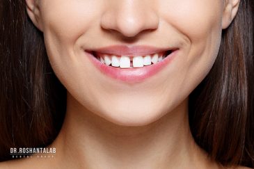 اصلاح فاصله بین دندان ها