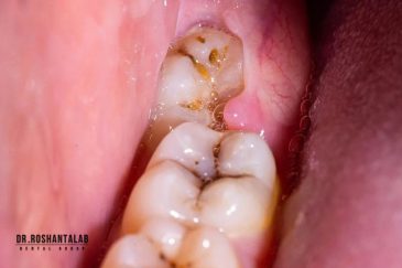 عفونت دندان عقل و درمان آن