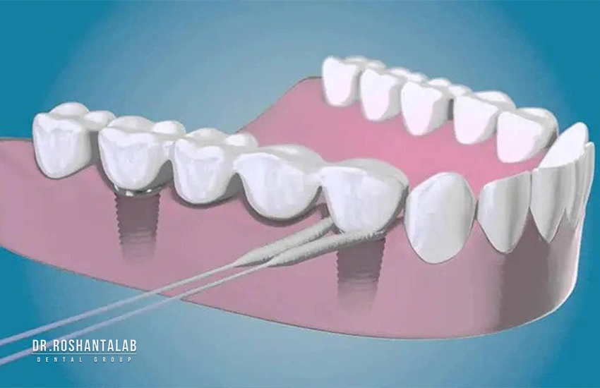 نخ دندان‌های اسفنجی (Super Floss).
