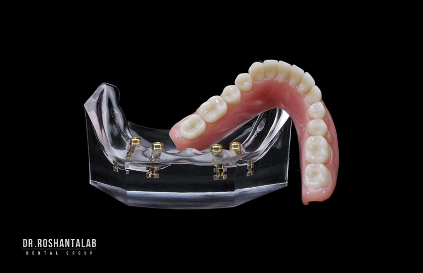 اوردنچر با اتصال لوکاتور (Locator Overdenture)