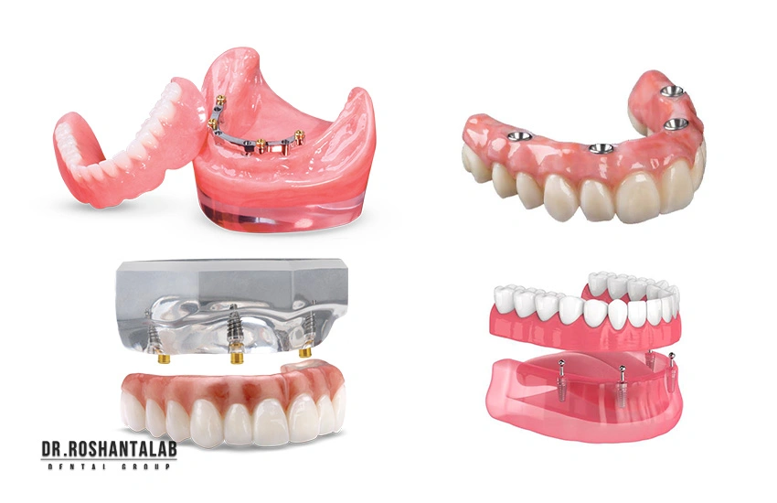 برای ثبات بیشتر در فک پایین یا بالا چه کنیم؟ کدام نوع اوردنچر مناسب است؟