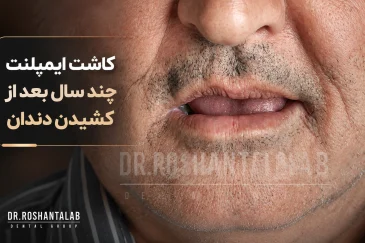 کاشت ایمپلنت چند سال بعد از کشیدن دندان