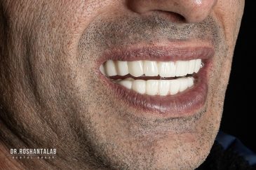 دندان مصنوعی ثابت بر پایه ایمپلنت