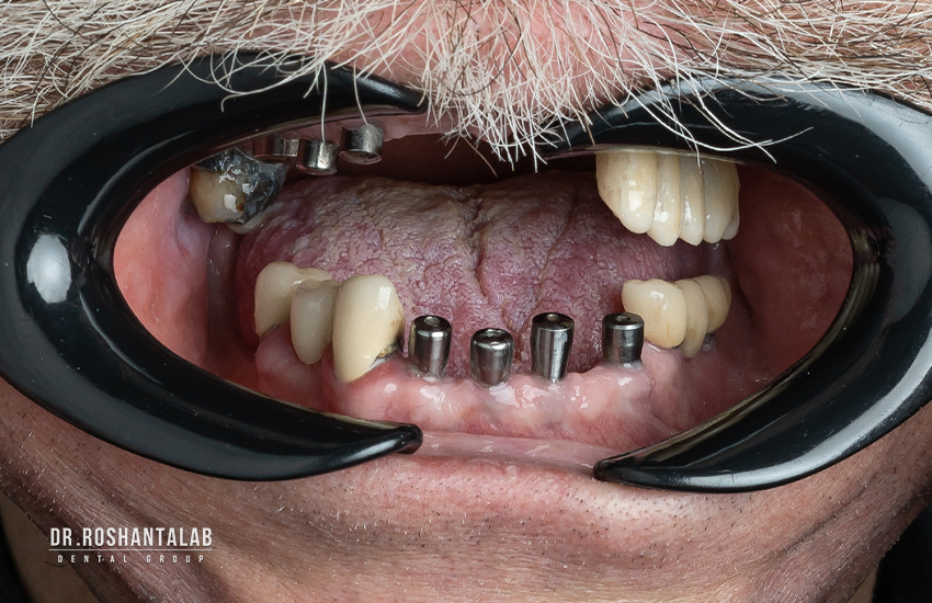 تاثیر ایمپلنت بر سلامت استخوان فک