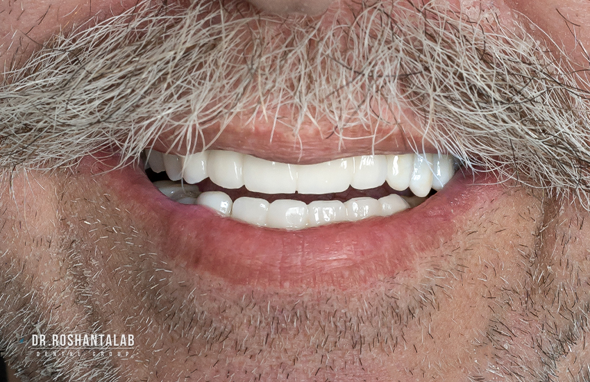 تاثیر ایمپلنت بر سلامت استخوان فک