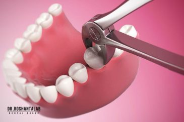 کشیدن دندان و تحلیل استخوان