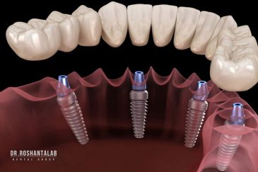 بهترین کلینیک تخصصی ایمپلنت رشا