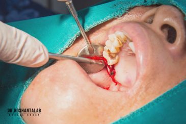 کشیدن دندان عفونی - عوارض و مراقبت ها