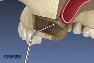 جراحی سینوس لیفت