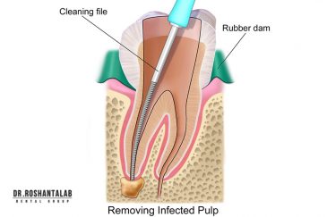 عصب کشی دندان عفونی