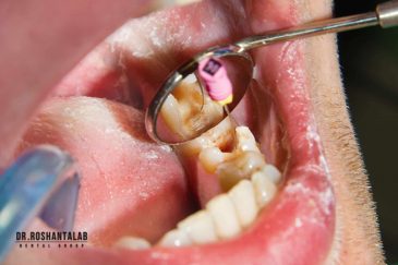درمان ریشه یا Root Canal Therapy