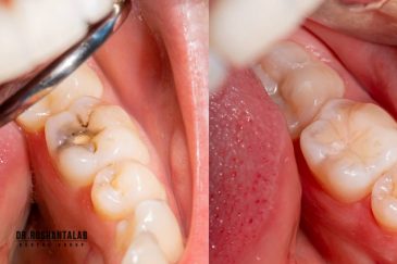 پر کردن دندان با کامپوزیت بهتر است یا آمالگام؟