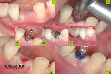 کاشت ایمپلنت به روش پانچ : بدون جراحی