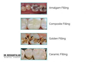 عمر دندان پر شده چقدر است؟