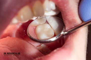 کامپوزیت روی دندان عصب‌کشی شده