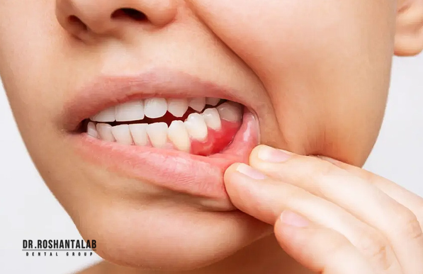 درمان بیماری‌های لثه قبل از ایمپلنت