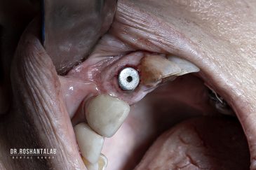 ايمپلنت بدون درد