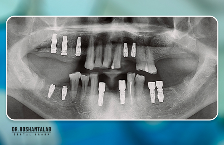 دوره نقاهت ایمپلنت دندان و زمان بهبودی چند روز یا چند ماه؟!
