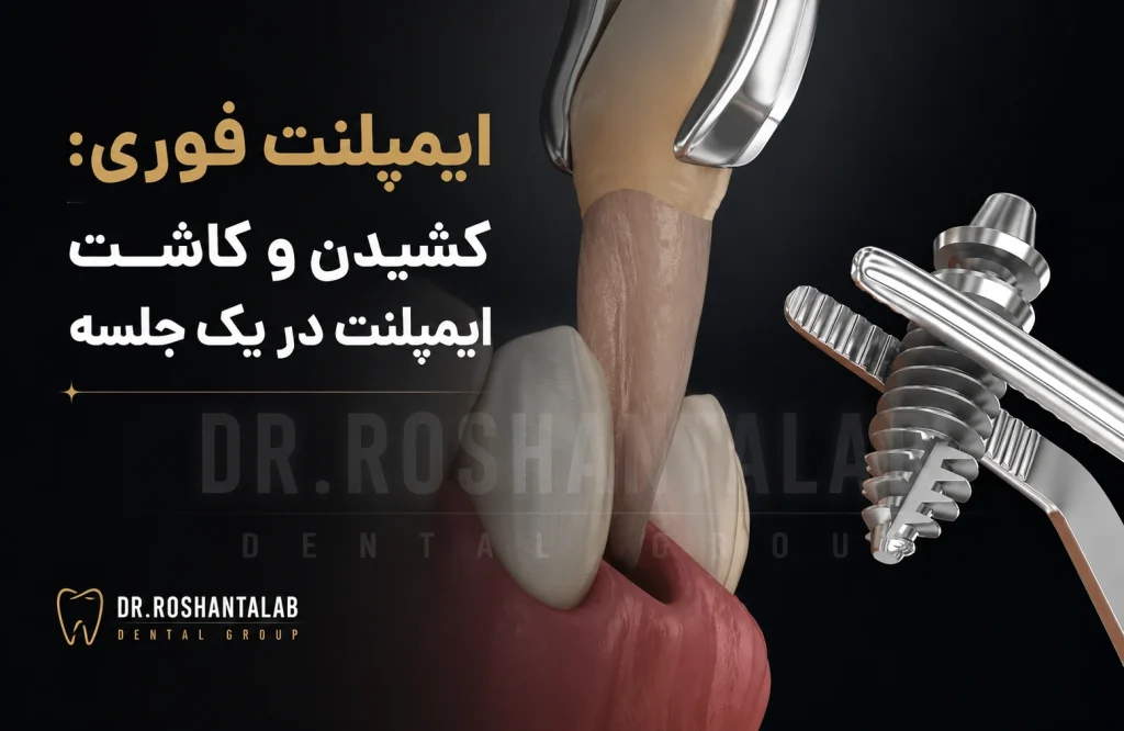 ایمپلنت فوری بهتر است یا پیوند استخوان بعد از کشیدن؟
