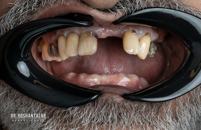 تاثیر ایمپلنت بر سلامت استخوان فک