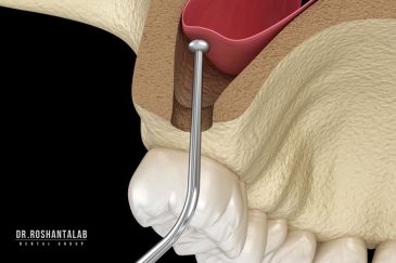 مراقبت های ایمپلنت دندان