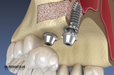 قیمت کاشت ایمپلنت دندان