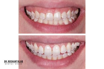 افزایش طول تاج دندان