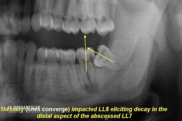 روش درمان دندان نهفته و نیمه نهفته چیست