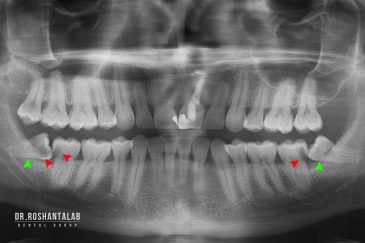 رادیوگرافی دندان چیست؟