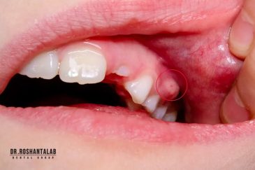 آبسه دندان چیست، علل و درمان آن