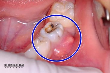 درمان آبسه دندان و لثه