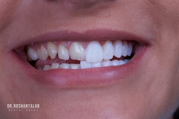 جرم گیری دندان لمینت شده