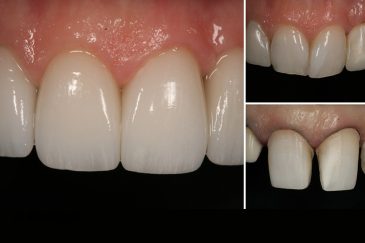 آیا روکش دندان باعث بروز بوی بد دهان می شوند؟