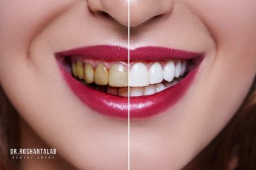 انواع سیاه شدن دندان و درمان آن