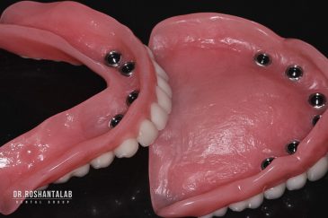 قیمت ایمپلنت کامل فک بالا و پایین