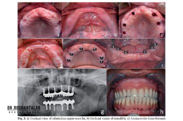 کاشت ایمپلنت پانچ در رشت