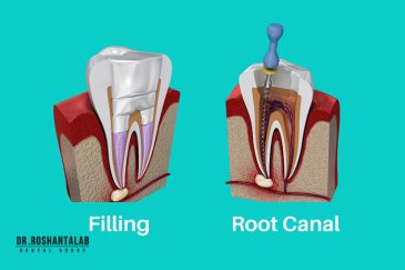 چه زمانی نیاز به درمان ریشه دندان دارید؟