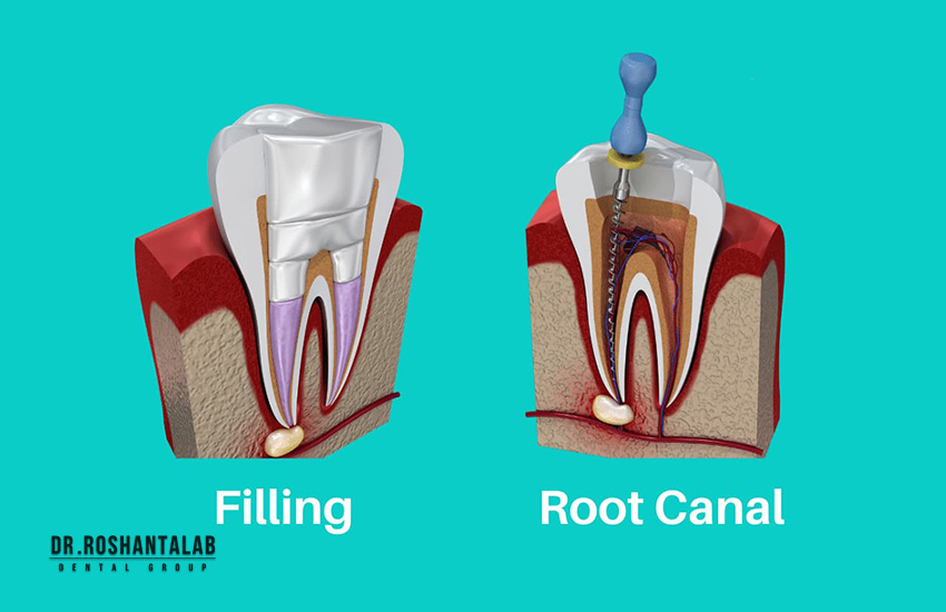 چه زمانی نیاز به درمان ریشه دندان دارید؟
