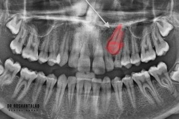 دندان نهفته چیست و چه عوارضی دارد؟
