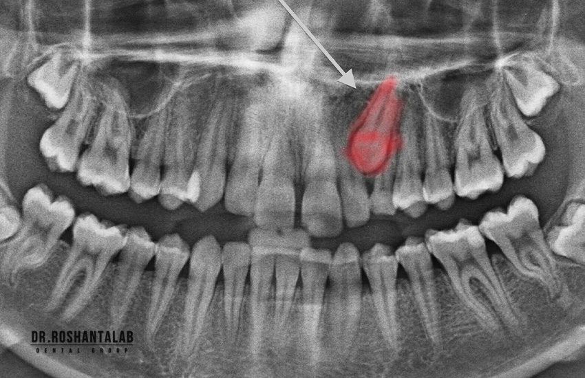 دندان نهفته چیست و چه عوارضی دارد؟