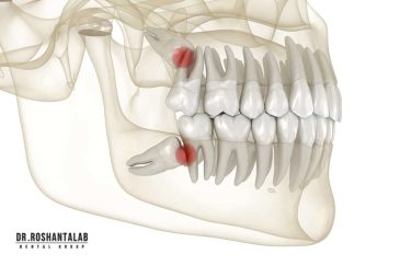 کشیدن دندان عقل بالا راحت ‌تره یا پایین؟