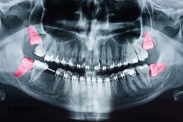 کشیدن دندان عقل