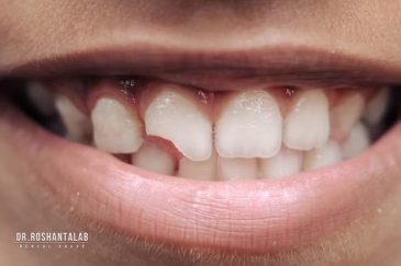 درمان دندان لب پرشده یا شکسته شده