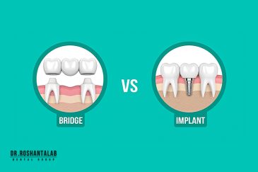 تفاوت ایمپلنت با بریج