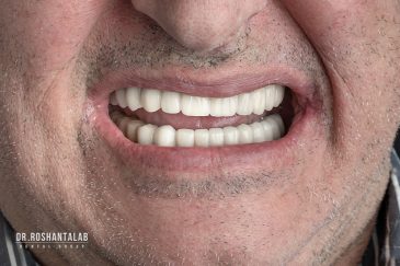 ایمپلنت کل دهان در رشت