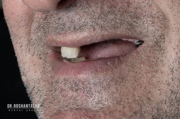 عوارض نداشتن دندان چیست؟