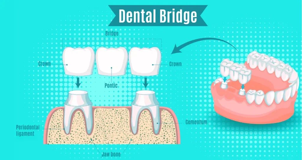 تفاوت ایمپلنت با بریج : کدام بهتر است؟