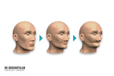 تحلیل لثه پس از دندان مصنوعی