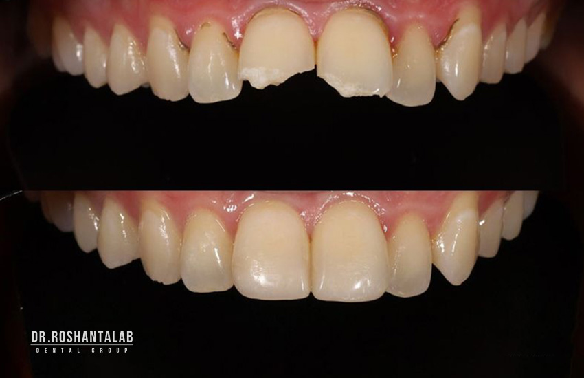 ترمیم دندان شکسته چگونه صورت می گیرد؟